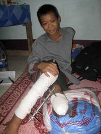 A 14-year-old victim of landmine in Burma